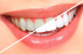 Teeth Whitening - Bleaching
