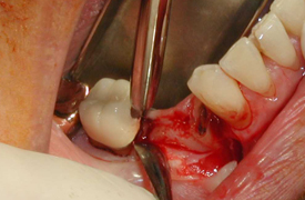 Tooth Extraction Treatment/clinic In Pune & Solapur - Dr. Nargide's Smera