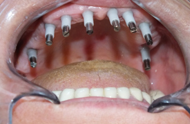 Dental Implants Clinic In Pune & Solapur